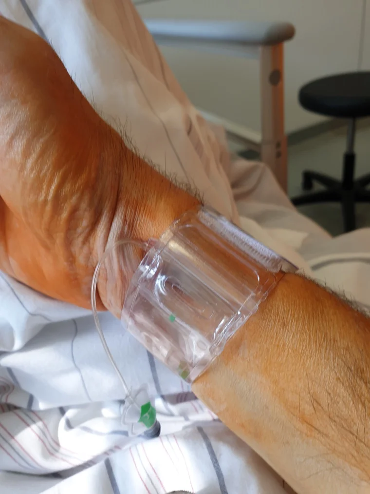 Katheter gut überstanden. Technik rein, Leben zurück.