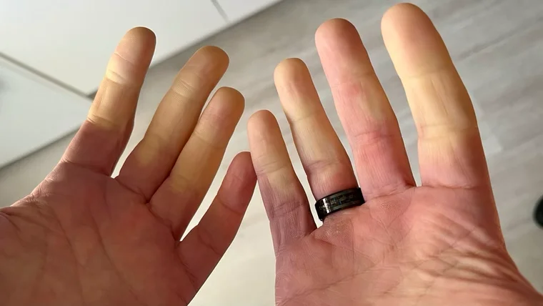 Finger ohne Durchblutung – die "Faust in der Tasche" bringt etwas Wärme zurück